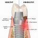 Comparative illustration showing a healthy dental implant with intact gum tissue and bone versus an unhealthy implant affected by plaque, inflammation, and bone loss indicative of peri-implantitis.