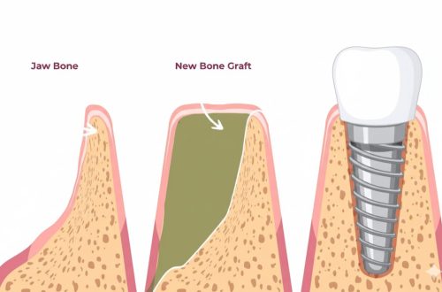 Sequential diagram illustrating bone grafting process for dental implants. Left shows jaw bone atrophy (resorption). Middle shows new bone graft material filling the defect during the healing process. Right shows a dental implant successfully placed into the newly regenerated bone