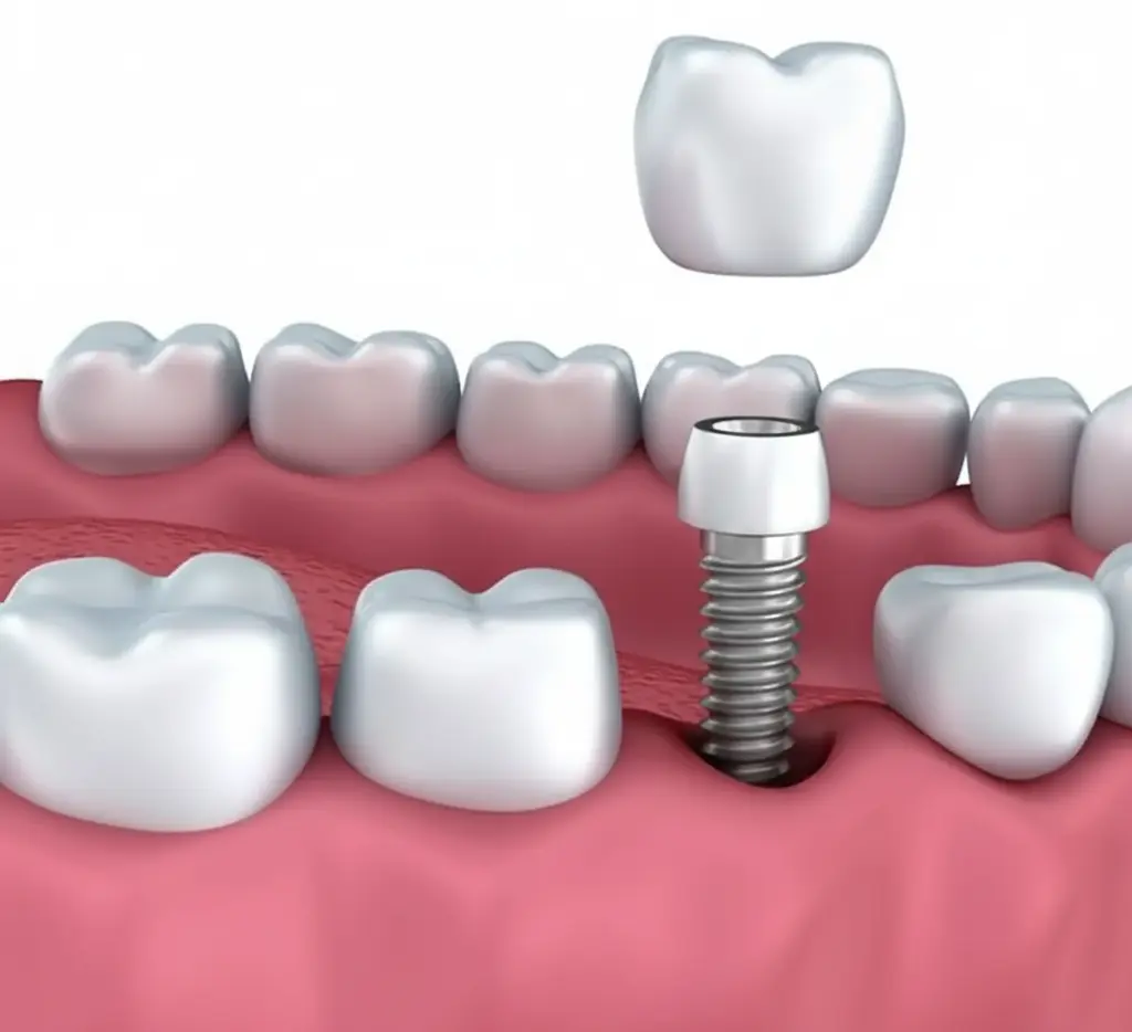 Cross-section diagram illustrating the components of a dental implant restoration: the titanium implant post, the abutment, and the dental crown placed above the gum line