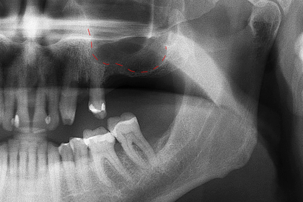 X-ray animation (GIF) demonstrating a sinus lift procedure, showing the maxillary sinus floor being elevated and bone graft material (highlighted in red dashed lines) being placed to increase bone volume for dental implant