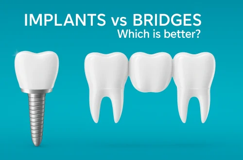 Comparison illustration of a dental implant and a dental bridge, showing a single implant with titanium screw on the left and a three-unit bridge with a pontic in the middle on the right, with text “Implants vs Bridges – Which is better?” on a blue background.