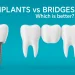 Comparison illustration of a dental implant and a dental bridge, showing a single implant with titanium screw on the left and a three-unit bridge with a pontic in the middle on the right, with text “Implants vs Bridges – Which is better?” on a blue background.