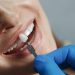 dentist whiting teeth, same-day implants