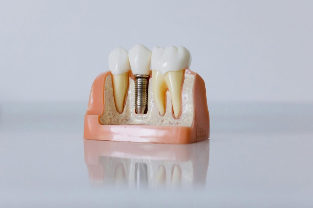 A cross-sectional dental model showing a titanium implant inserted into the jawbone between two natural teeth, demonstrating how dental implants are anchored in place.